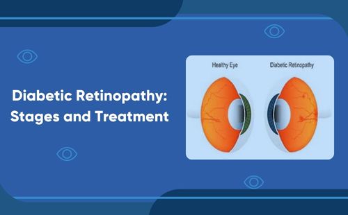 Diabetic Retinopathy: Stages and Treatment 
