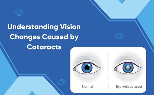 Understanding Vision Changes Caused by Cataracts
