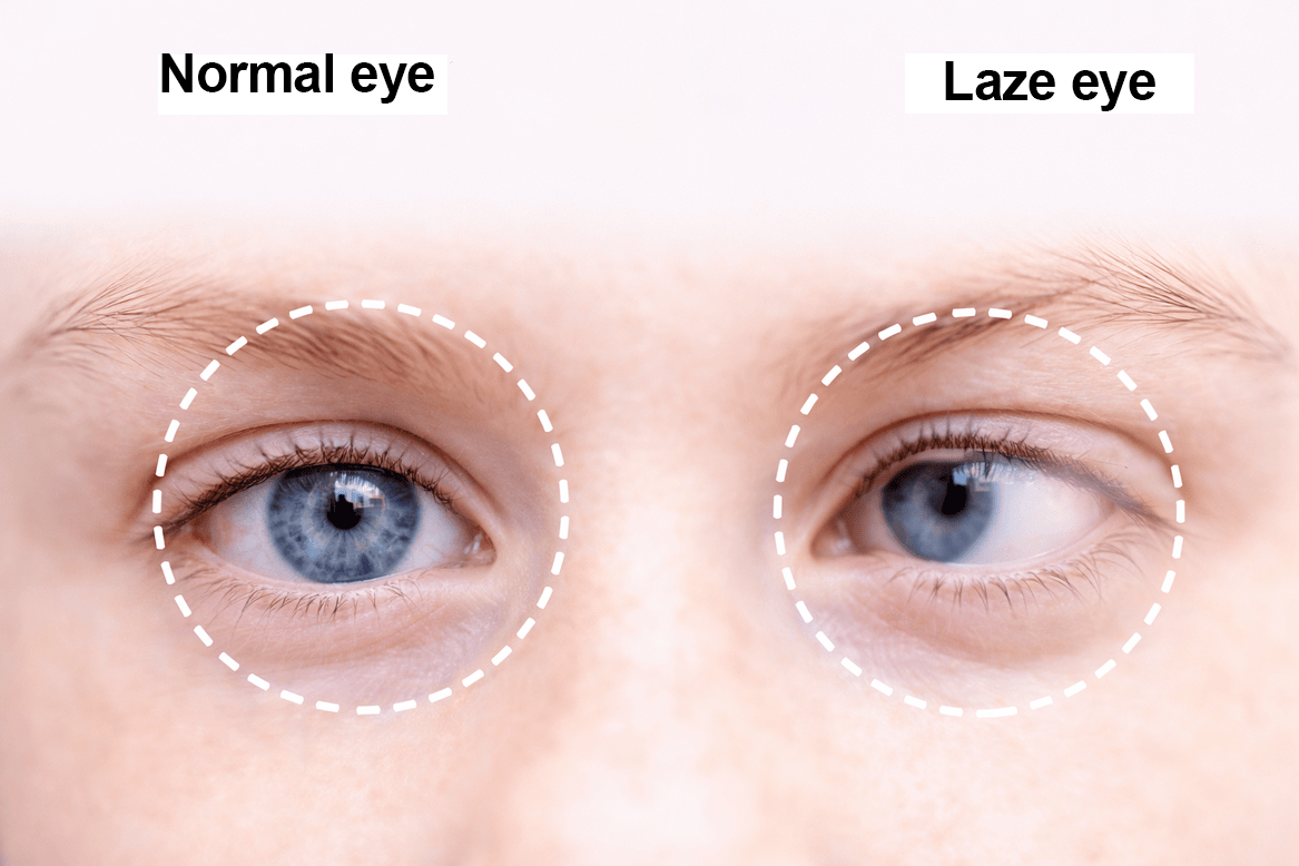 Lazy Eye (Amblyopia)